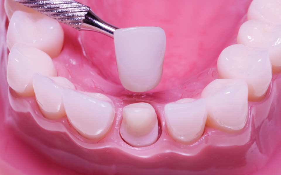 Dental Crowns and Bridges In Pimpri Chinchwad Dental Crowns and Bridges In Pimpri Chinchwad Pune