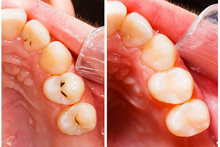 Dental Crowns and Bridges In Pimpri Chinchwad Dental Crowns and Bridges In Pimpri Chinchwad Pune