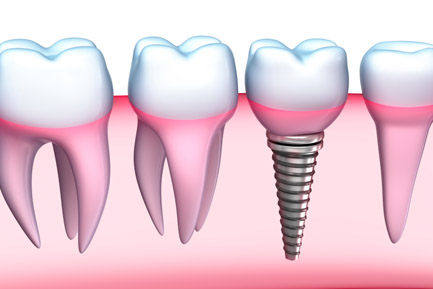 Dental Crowns and Bridges In Pimpri Chinchwad Dental Crowns and Bridges In Pimpri Chinchwad Pune