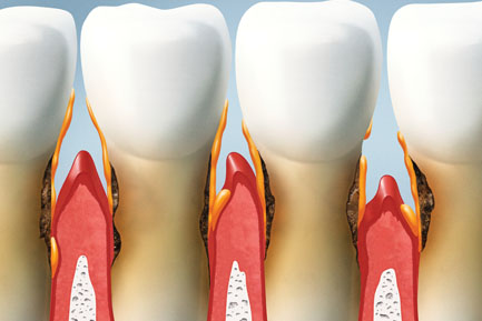 Gum Surgery Treatment in Pimpri Chinchwad Gum Surgery Treatment in Pimpri Chinchwad Pune