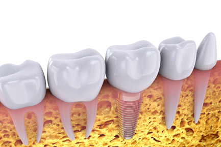 Best Dental Implant Clinic in Pimpri Chinchwad Best Dental Implant Clinic in Pimpri Chinchwad Pune