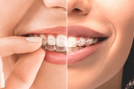 Best Orthodontist in Pimpri Chinchwad Best Orthodontist in Pimpri Chinchwad Pune