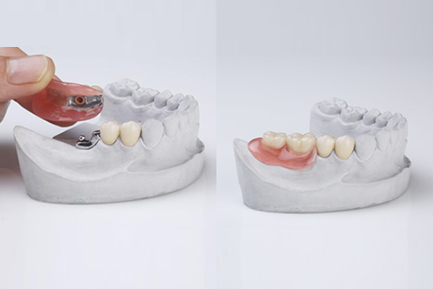 Dental Crowns and Bridges In Pimpri Chinchwad Dental Crowns and Bridges In Pimpri Chinchwad Pune