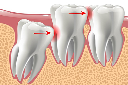 Dental Crowns and Bridges In Pimpri Chinchwad Dental Crowns and Bridges In Pimpri Chinchwad Pune